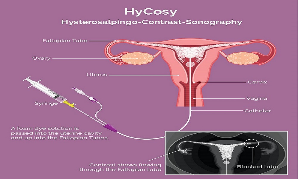 Hysterosalpingo-contrast sonography(HyCoSy)